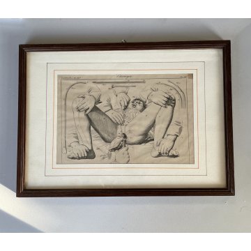 ANTICA STAMPA incisione OPERAZIONE CHIRURGIA illustrazione medica ENCICLOPEDIA