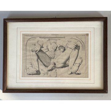 ANTICA STAMPA incisione OPERAZIONE CHIRURGIA illustrazione medica ENCICLOPEDIA