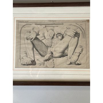 ANTICA STAMPA incisione OPERAZIONE CHIRURGIA illustrazione medica ENCICLOPEDIA