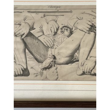 ANTICA STAMPA incisione OPERAZIONE CHIRURGIA illustrazione medica ENCICLOPEDIA