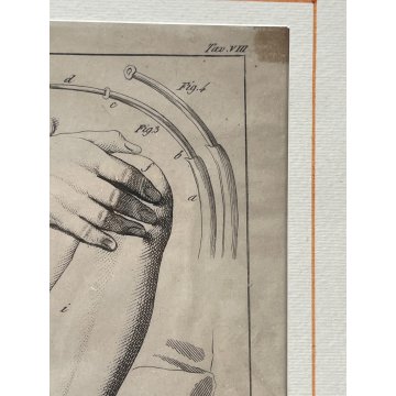ANTICA STAMPA incisione OPERAZIONE CHIRURGIA illustrazione medica ENCICLOPEDIA