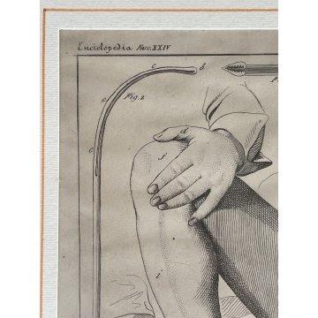 ANTICA STAMPA incisione OPERAZIONE CHIRURGIA illustrazione medica ENCICLOPEDIA