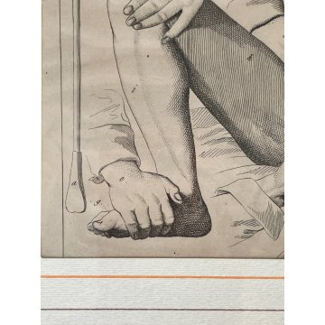 ANTICA STAMPA incisione OPERAZIONE CHIRURGIA illustrazione medica ENCICLOPEDIA